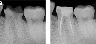 根管治療・罰随処置